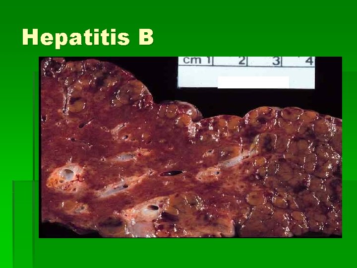Hepatitis B 