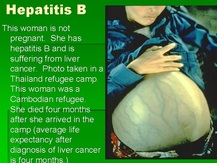 Hepatitis B This woman is not pregnant. She has hepatitis B and is suffering