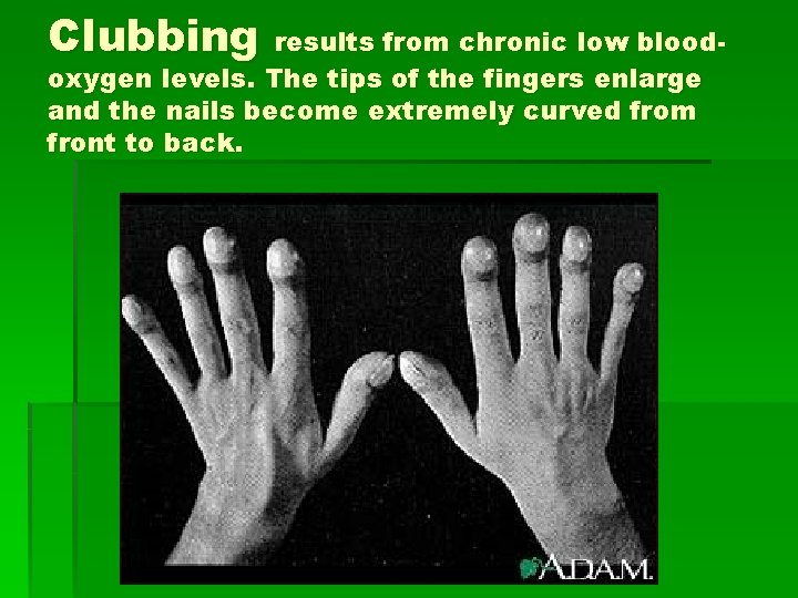 Clubbing results from chronic low bloodoxygen levels. The tips of the fingers enlarge and