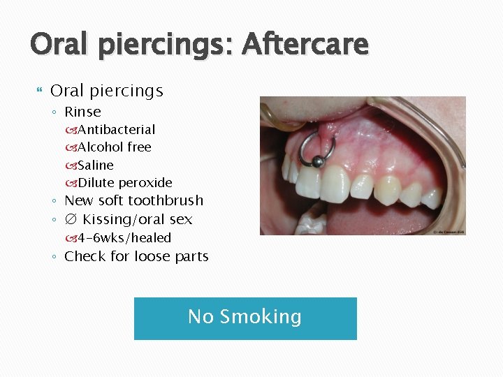 Oral piercings: Aftercare Oral piercings ◦ Rinse Antibacterial Alcohol free Saline Dilute peroxide ◦