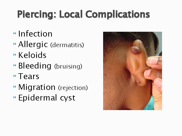 Piercing: Local Complications Infection Allergic (dermatitis) Keloids Bleeding (bruising) Tears Migration (rejection) Epidermal cyst