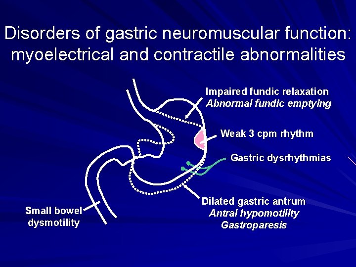 Disorders of gastric neuromuscular function: myoelectrical and contractile abnormalities Impaired fundic relaxation Abnormal fundic