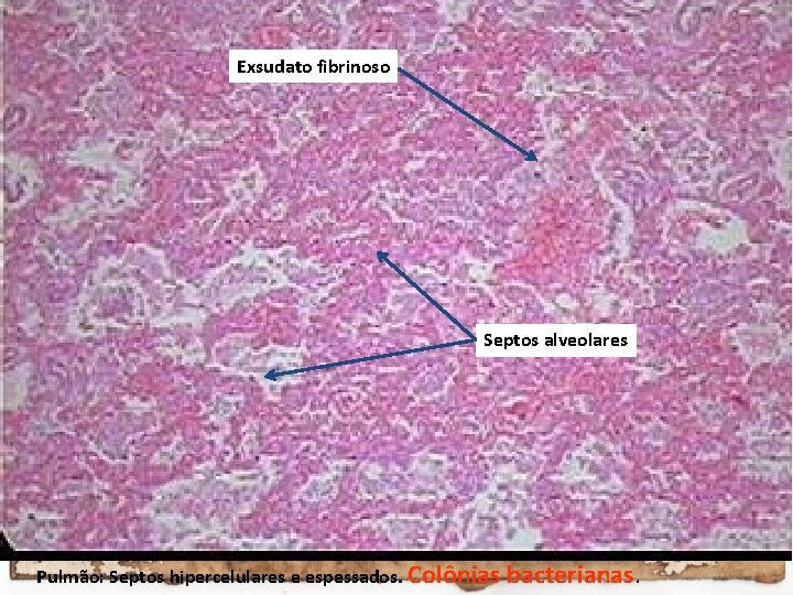 Exsudato fibrinoso Septos alveolares Pulmão: Septos hipercelulares e espessados. Colônias bacterianas. 