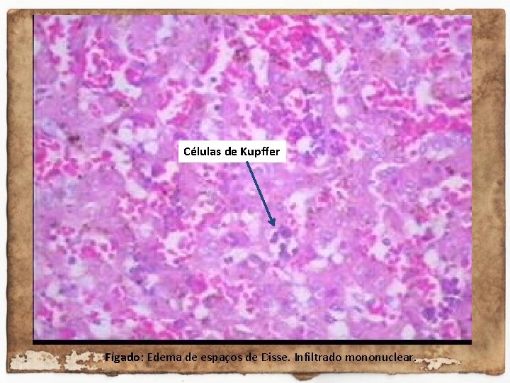 Células de Kupffer Fígado: Edema de espaços de Disse. Infiltrado mononuclear. 