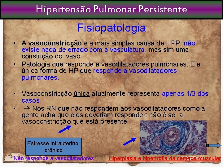 Hipertensão Pulmonar Persistente Fisiopatologia • A vasoconstricção é a mais simples causa de HPP: