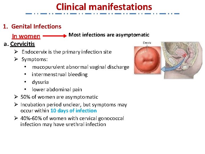 Clinical manifestations 1. Genital Infections In women a. Cervicitis Most infections are asymptomatic Ø