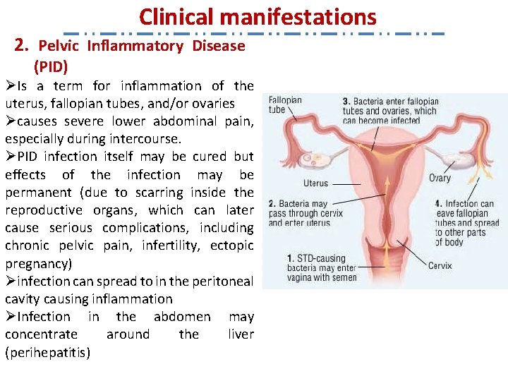 Clinical manifestations 2. Pelvic Inflammatory Disease (PID) ØIs a term for inflammation of the