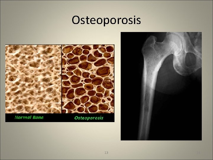 Osteoporosis 13 14 