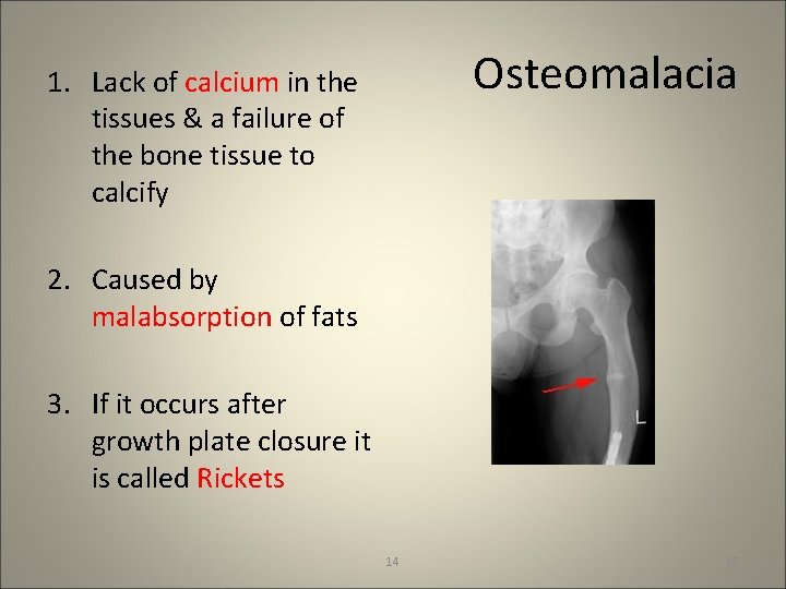 Osteomalacia 1. Lack of calcium in the tissues & a failure of the bone