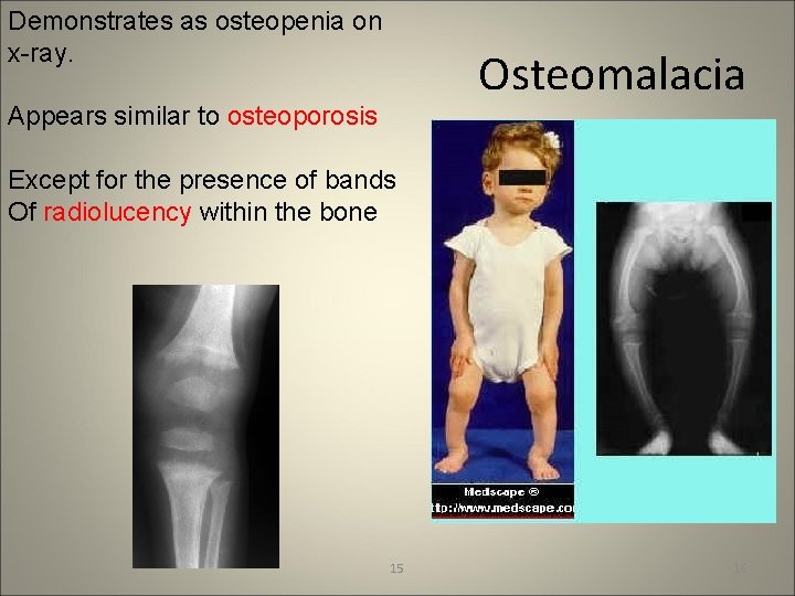 Demonstrates as osteopenia on x-ray. Osteomalacia Appears similar to osteoporosis Except for the presence