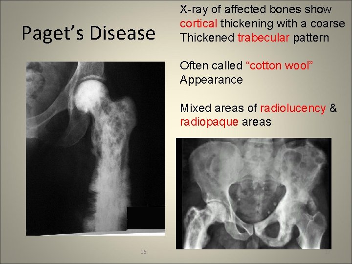 Paget’s Disease X-ray of affected bones show cortical thickening with a coarse Thickened trabecular