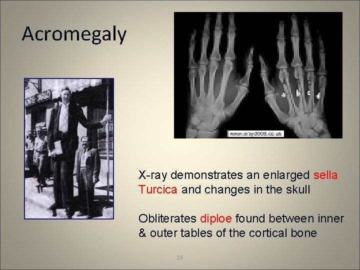 Acromegaly X-ray demonstrates an enlarged sella Turcica and changes in the skull Obliterates diploe