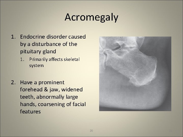 Acromegaly 1. Endocrine disorder caused by a disturbance of the pituitary gland 1. Primarily