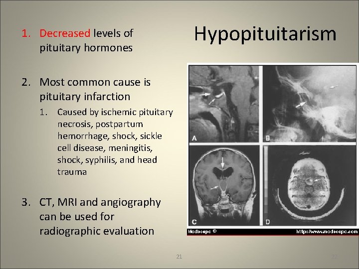 Hypopituitarism 1. Decreased levels of pituitary hormones 2. Most common cause is pituitary infarction