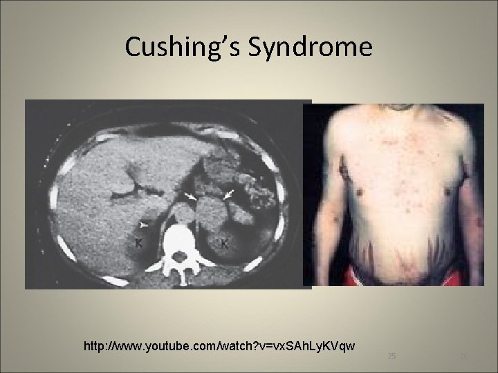 Cushing’s Syndrome http: //www. youtube. com/watch? v=vx. SAh. Ly. KVqw 25 26 