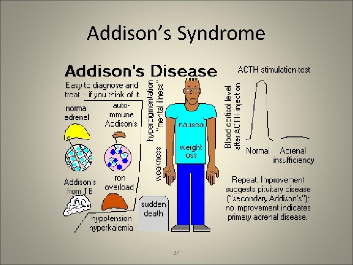 Addison’s Syndrome 27 28 