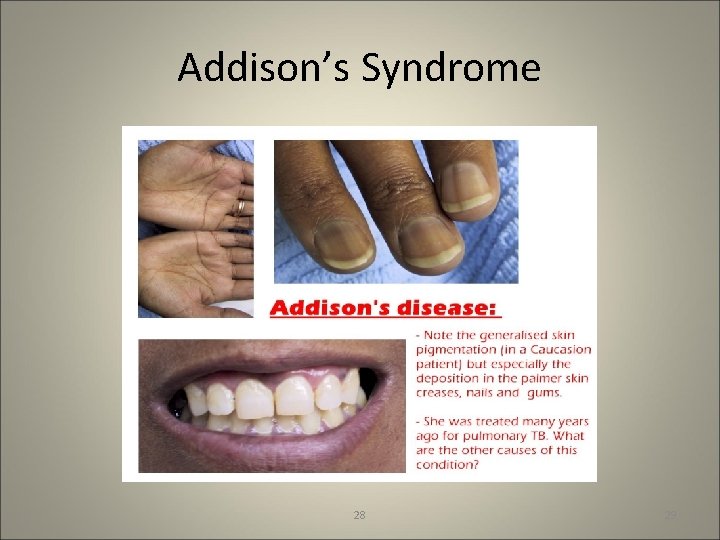 Addison’s Syndrome 28 29 