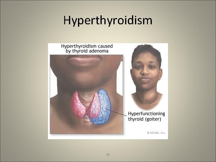 Hyperthyroidism 36 37 