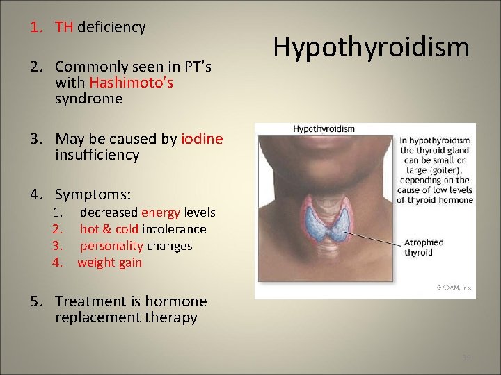 1. TH deficiency 2. Commonly seen in PT’s with Hashimoto’s syndrome Hypothyroidism 3. May