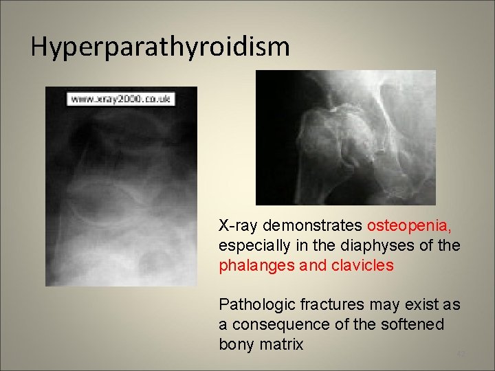 Hyperparathyroidism X-ray demonstrates osteopenia, especially in the diaphyses of the phalanges and clavicles Pathologic