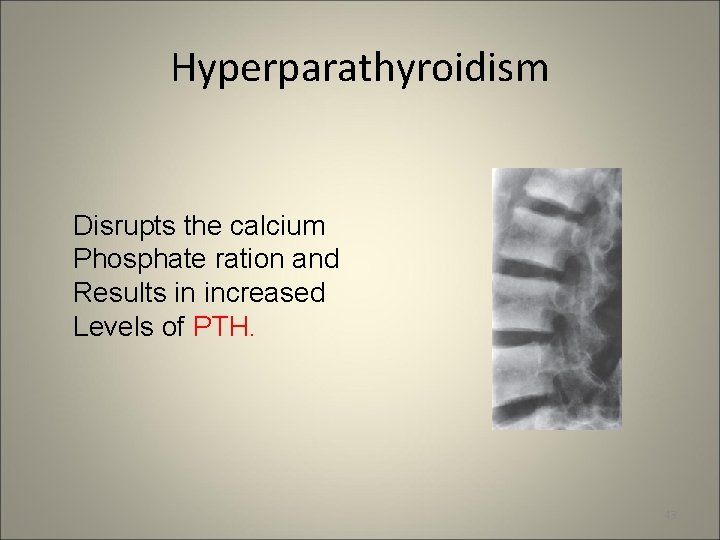 Hyperparathyroidism Disrupts the calcium Phosphate ration and Results in increased Levels of PTH. 43