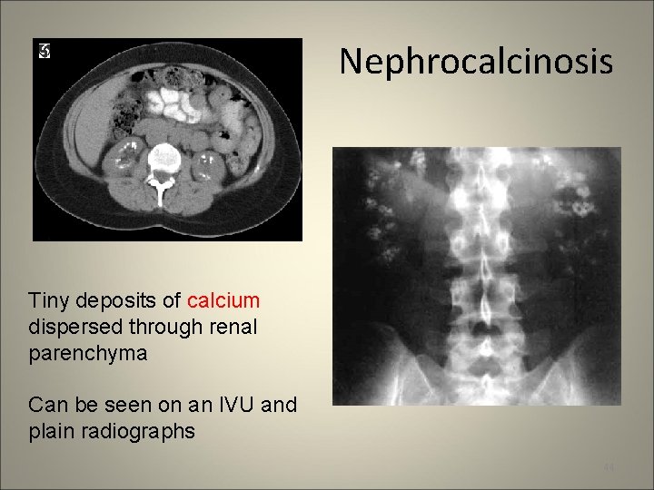 Nephrocalcinosis Tiny deposits of calcium dispersed through renal parenchyma Can be seen on an