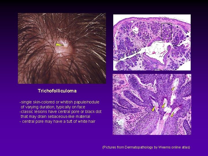 Trichofolliculoma -single skin-colored or whitish papule/nodule of varying duration, typically on face -classic lesions