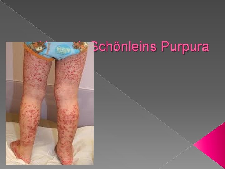 Henoch Schönleins Purpura 