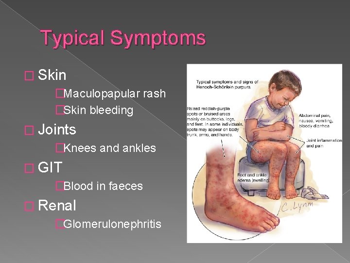 Typical Symptoms � Skin �Maculopapular rash �Skin bleeding � Joints �Knees and ankles �