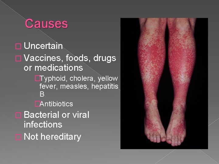 Causes � Uncertain � Vaccines, foods, drugs or medications �Typhoid, cholera, yellow fever, measles,