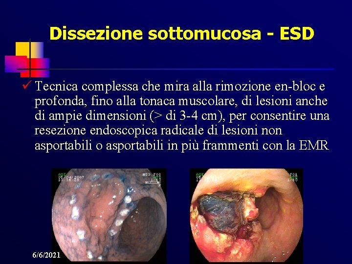 Dissezione sottomucosa - ESD ü Tecnica complessa che mira alla rimozione en-bloc e profonda,