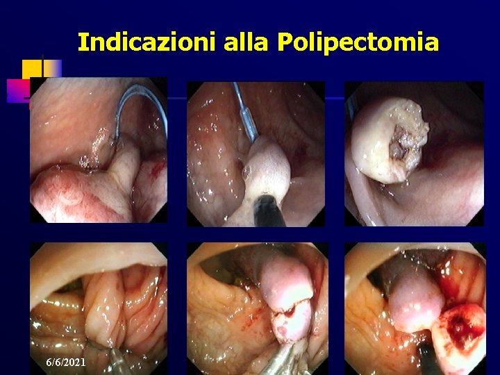 Indicazioni alla Polipectomia 6/6/2021 