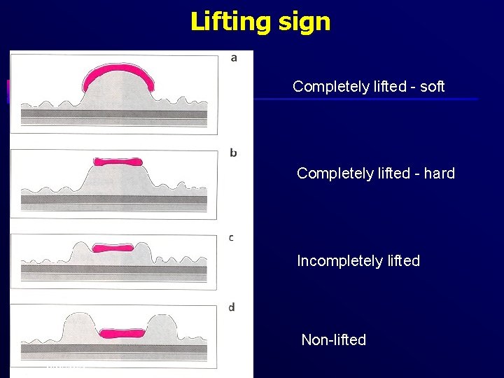 Lifting sign Completely lifted - soft Completely lifted - hard Incompletely lifted Non-lifted 6/6/2021
