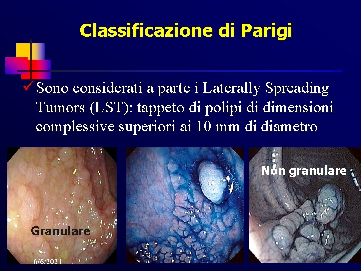 Classificazione di Parigi ü Sono considerati a parte i Laterally Spreading Tumors (LST): tappeto