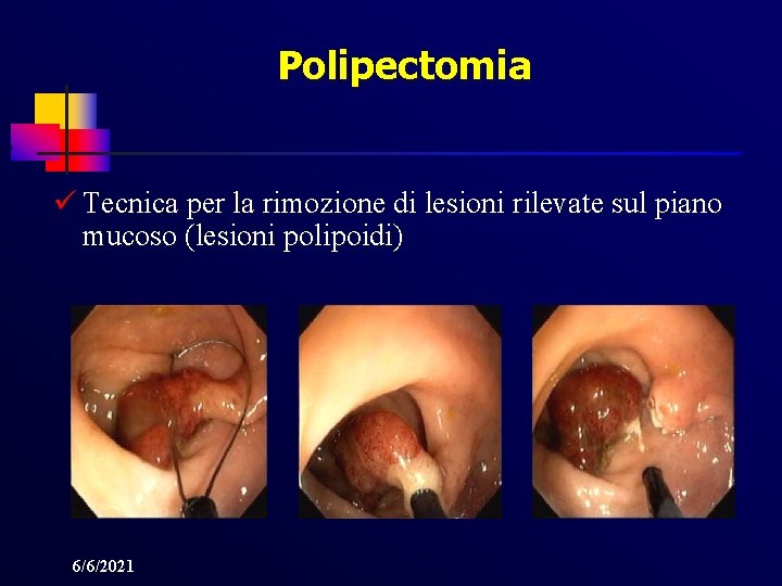 Polipectomia ü Tecnica per la rimozione di lesioni rilevate sul piano mucoso (lesioni polipoidi)