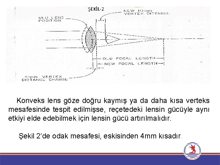 ŞEKİL-2 Konveks lens göze doğru kaymış ya da daha kısa verteks mesafesinde tespit edilmişse,