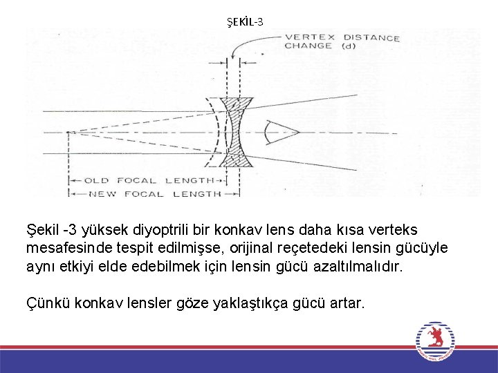 ŞEKİL-3 Şekil 3 yüksek diyoptrili bir konkav lens daha kısa verteks mesafesinde tespit edilmişse,