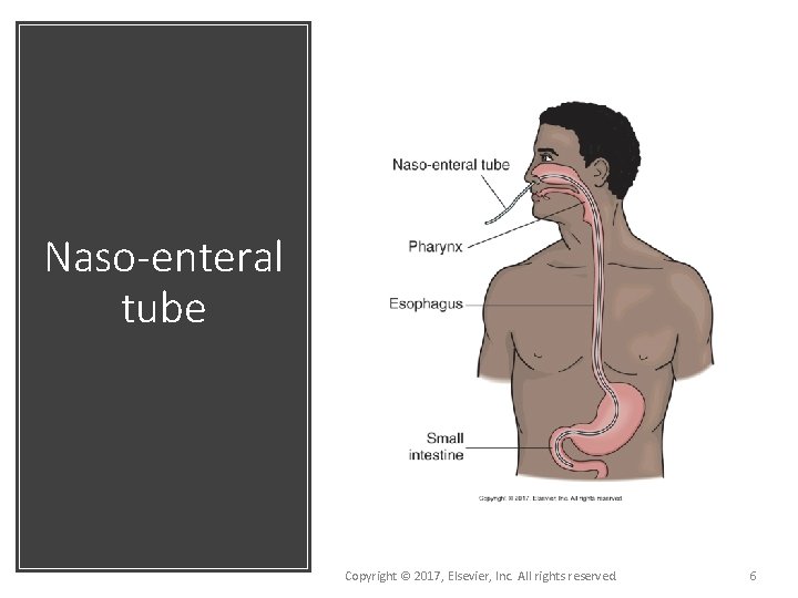 Naso-enteral tube Copyright © 2017, Elsevier, Inc. All rights reserved. 6 