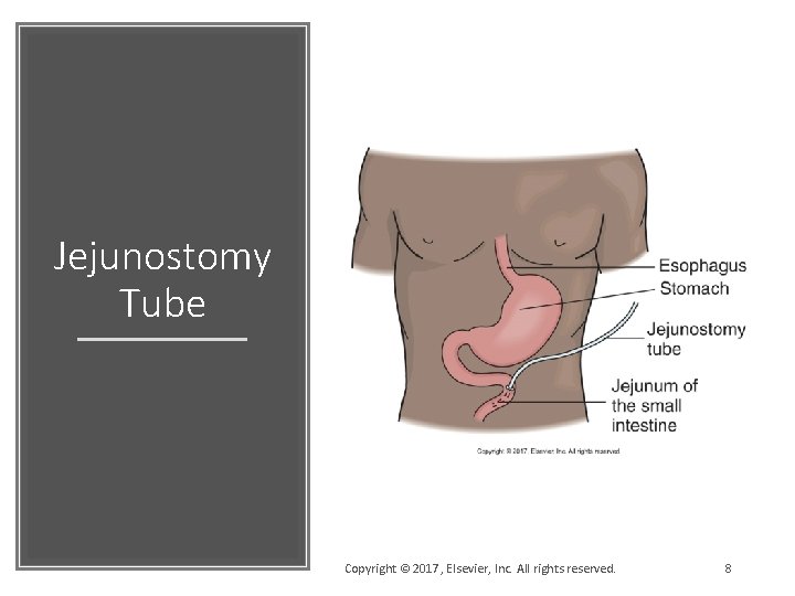 Jejunostomy Tube Copyright © 2017, Elsevier, Inc. All rights reserved. 8 