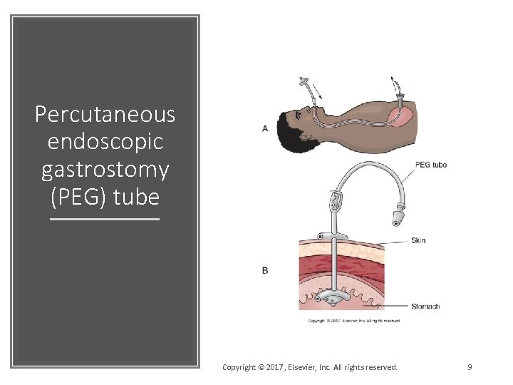 Percutaneous endoscopic gastrostomy (PEG) tube Copyright © 2017, Elsevier, Inc. All rights reserved. 9