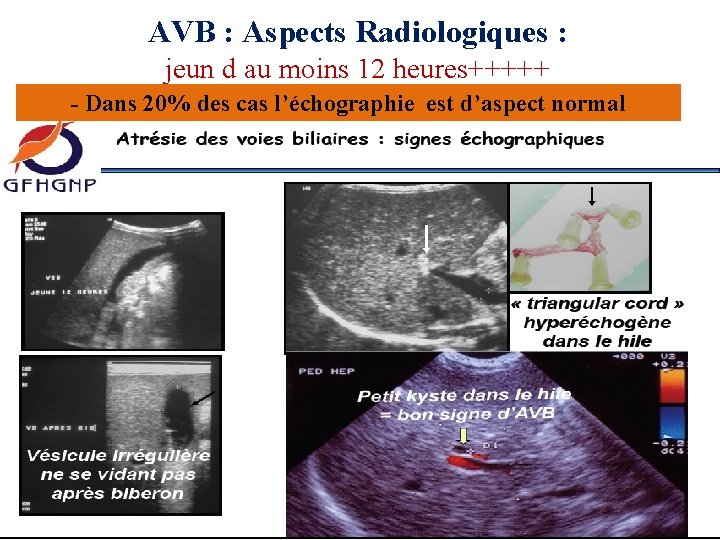 AVB : Aspects Radiologiques : jeun d au moins 12 heures+++++ - Dans 20%