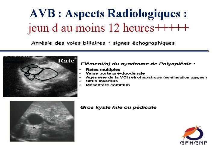 AVB : Aspects Radiologiques : jeun d au moins 12 heures+++++ 