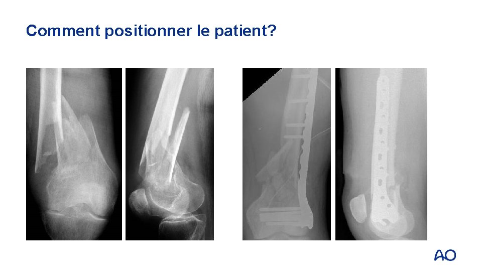 Comment positionner le patient? 