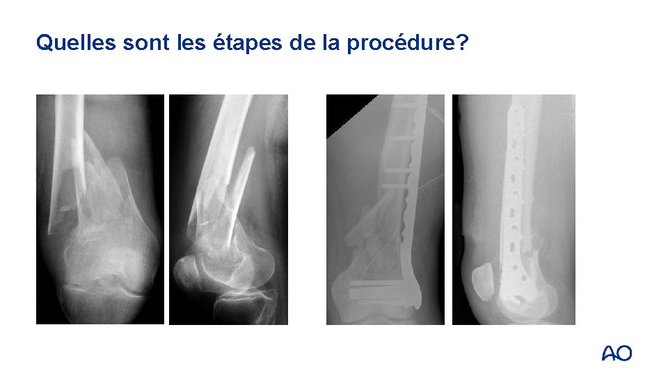 Quelles sont les étapes de la procédure? 