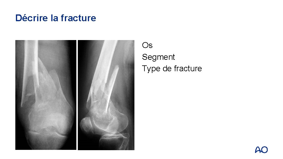 Décrire la fracture Os Segment Type de fracture 