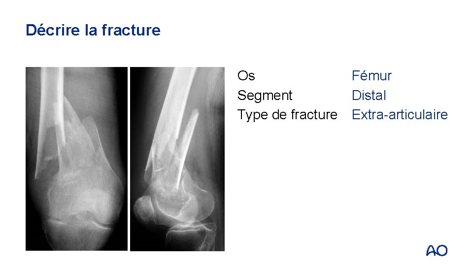 Décrire la fracture Os Segment Type de fracture Fémur Distal Extra-articulaire 