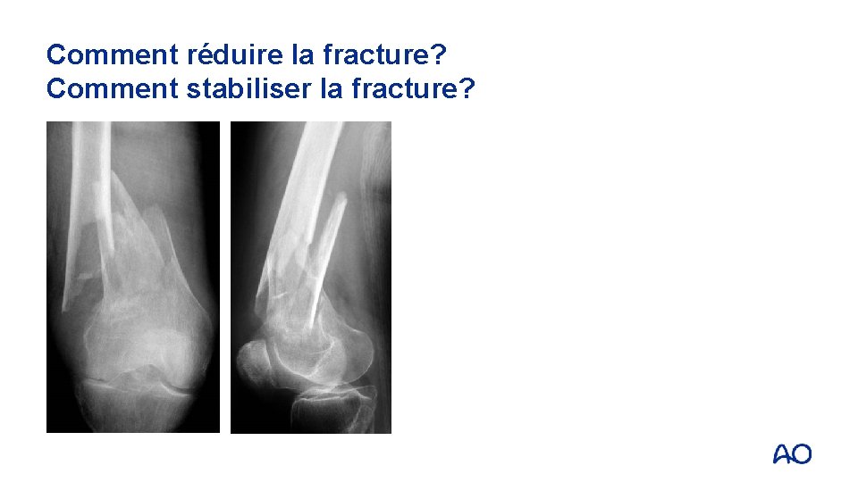 Comment réduire la fracture? Comment stabiliser la fracture? 