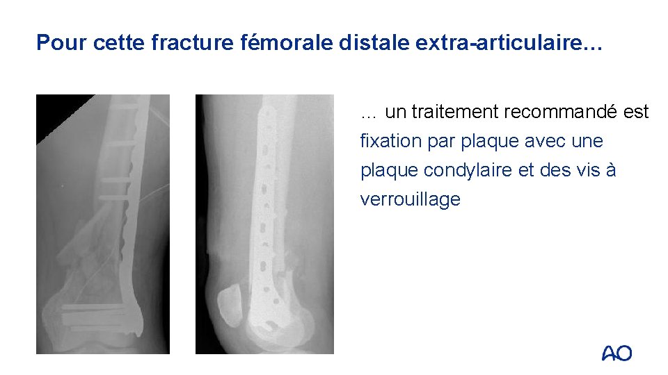 Pour cette fracture fémorale distale extra-articulaire… … un traitement recommandé est fixation par plaque