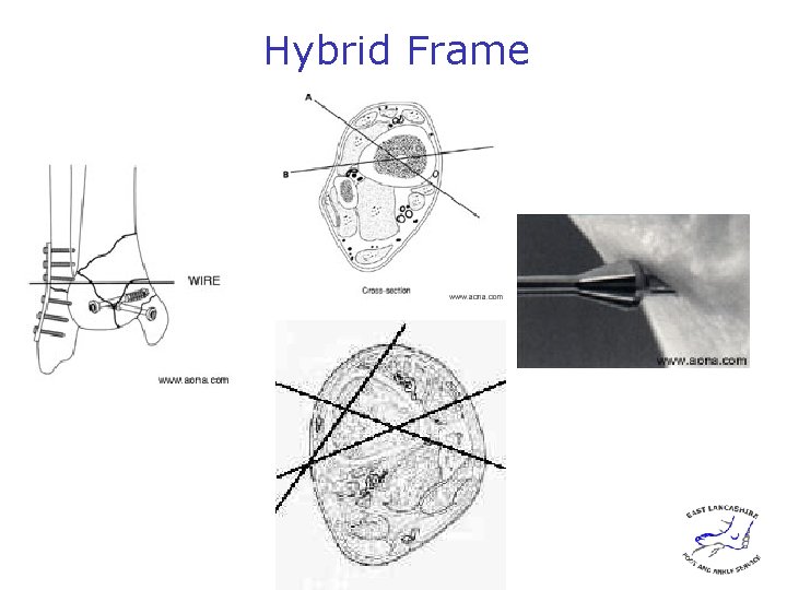 Hybrid Frame 