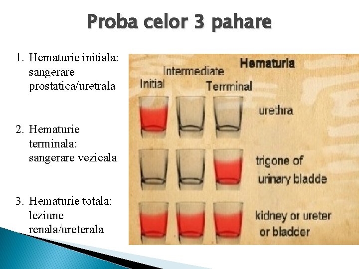 Proba celor 3 pahare 1. Hematurie initiala: sangerare prostatica/uretrala 2. Hematurie terminala: sangerare vezicala